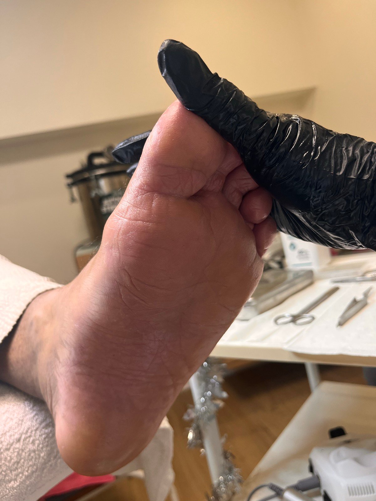 Depois — Ressecamento plantar