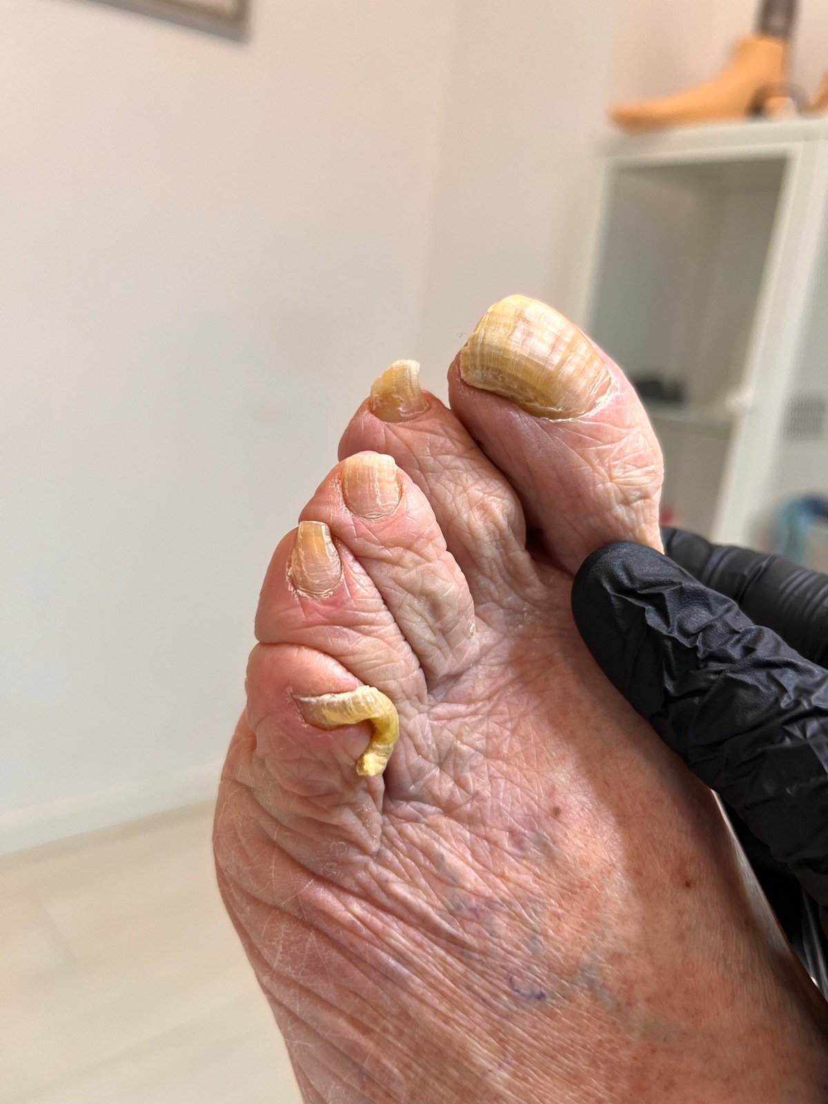 Antes — Unhas espessadas