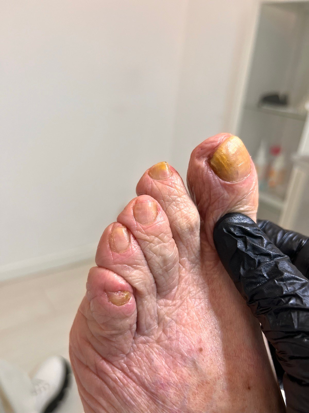 Depois — Unhas espessadas